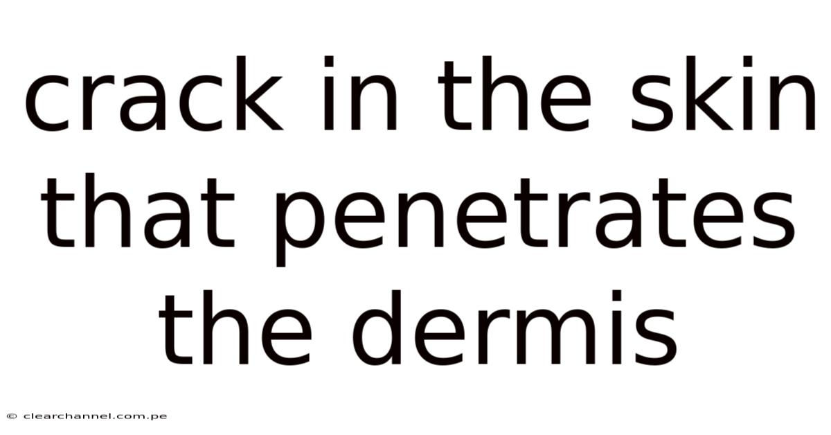 Crack In The Skin That Penetrates The Dermis