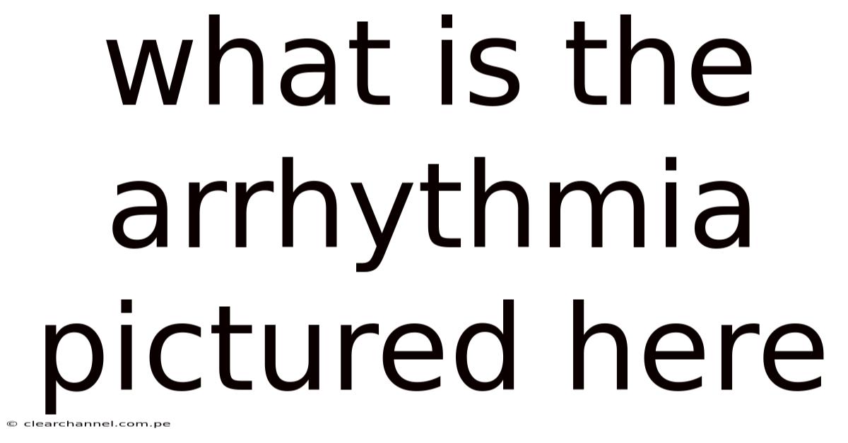What Is The Arrhythmia Pictured Here